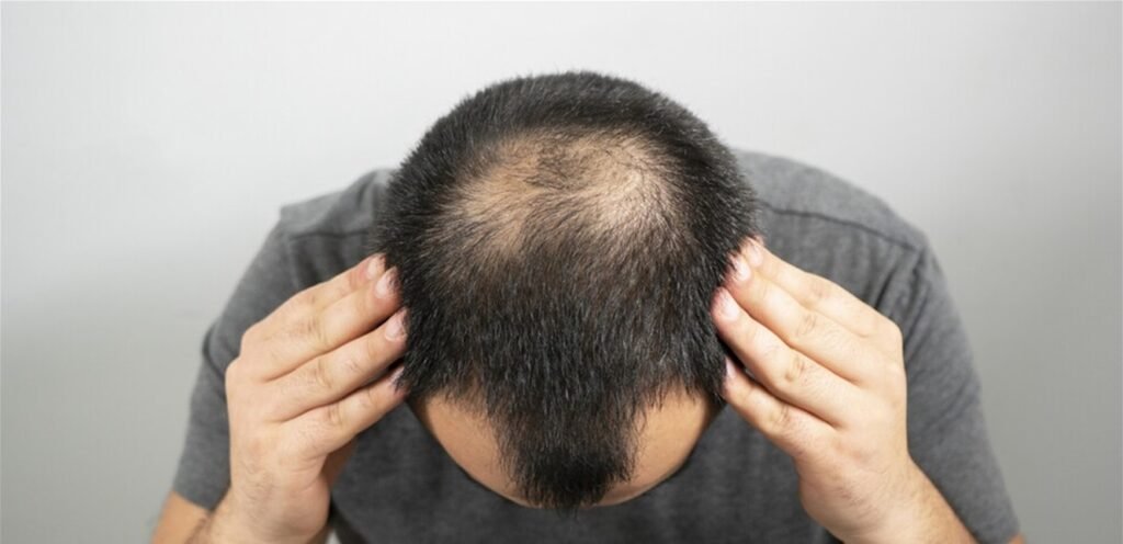 دراسة تكشف.. أسباب رئيسي لتساقط الشعر